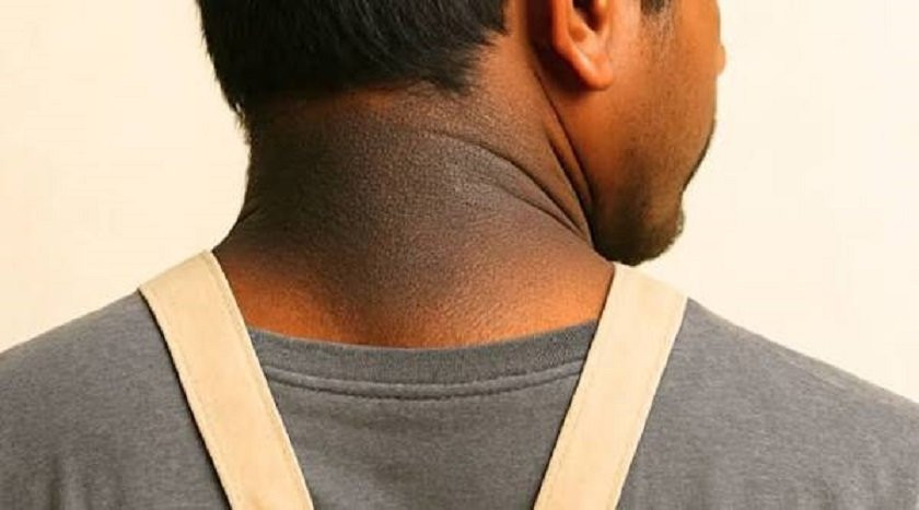गर्धन किन कालो हुन्छ? जान्नुहोस् कारण, आवश्यक परीक्षण र सही उपचार